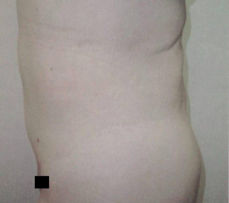 After lower body lift, side view, with Dr. Michelle Zweifler