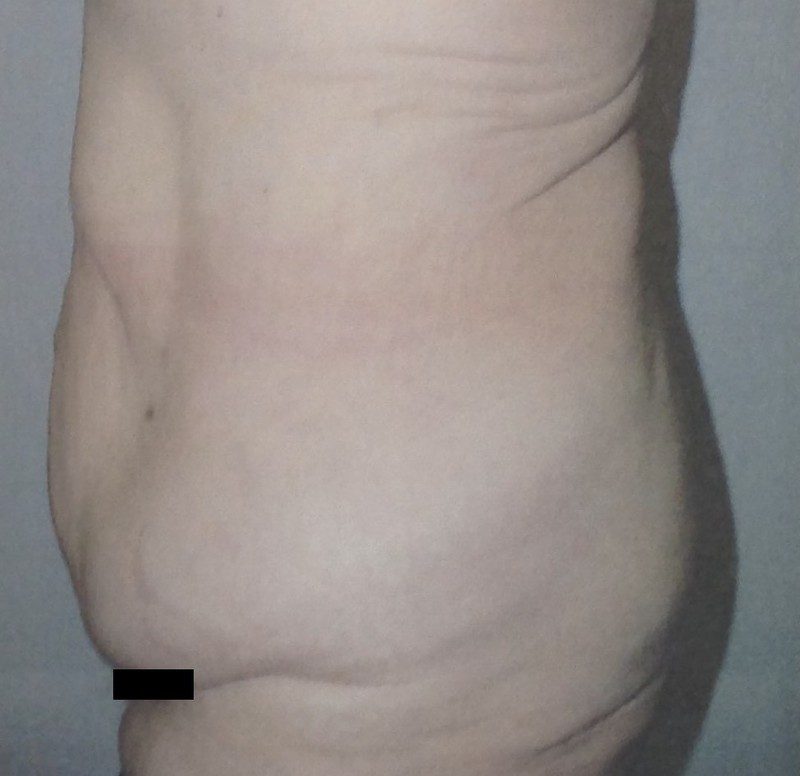 Before lower body lift, side view, with Dr. Michelle Zweifler