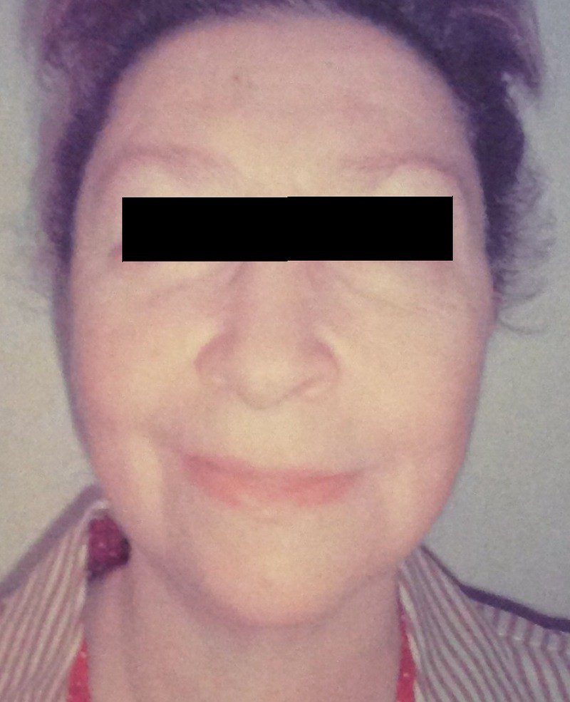 After facelift (eyes covered for privacy) with Dr. Michelle Zweifler