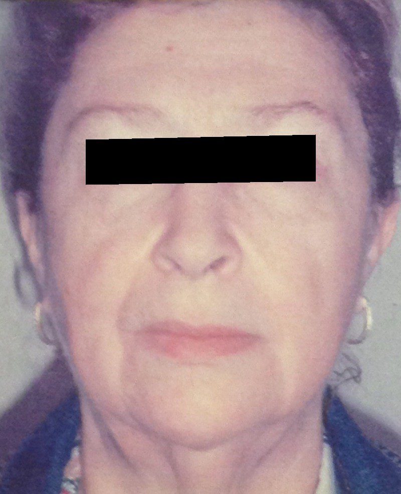 Before facelift (eyes covered for privacy) with Dr. Michelle Zweifler