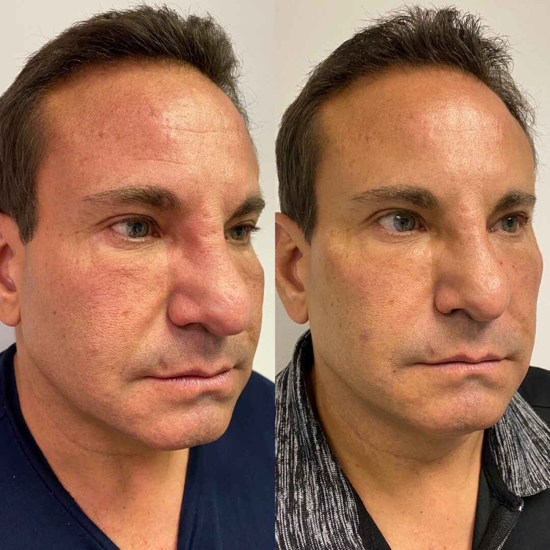 Before and after photos of a man's face.