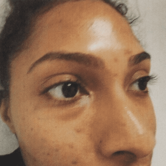 An image of a woman's face with blemishes.